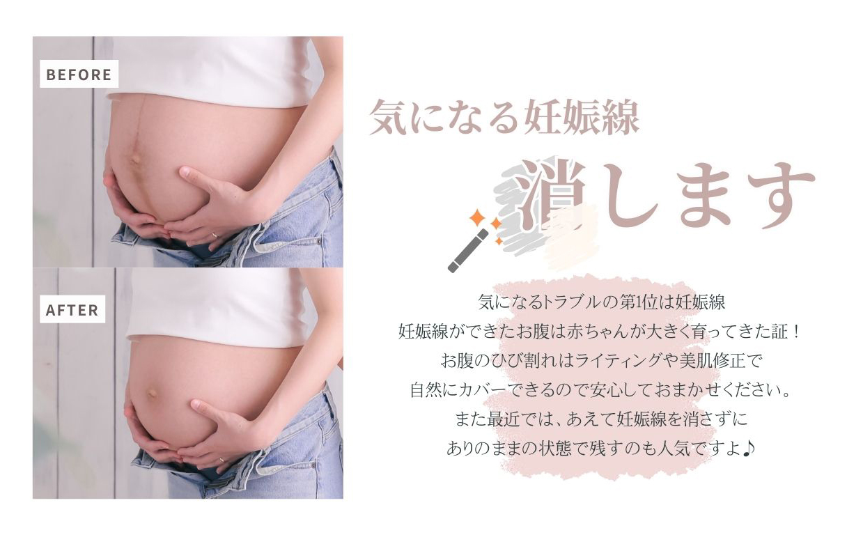 気になる妊娠線消します
