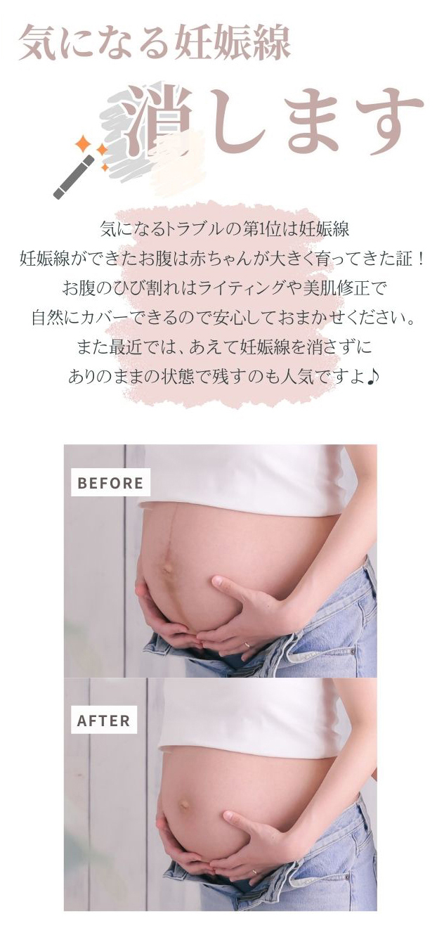 気になる妊娠線消します